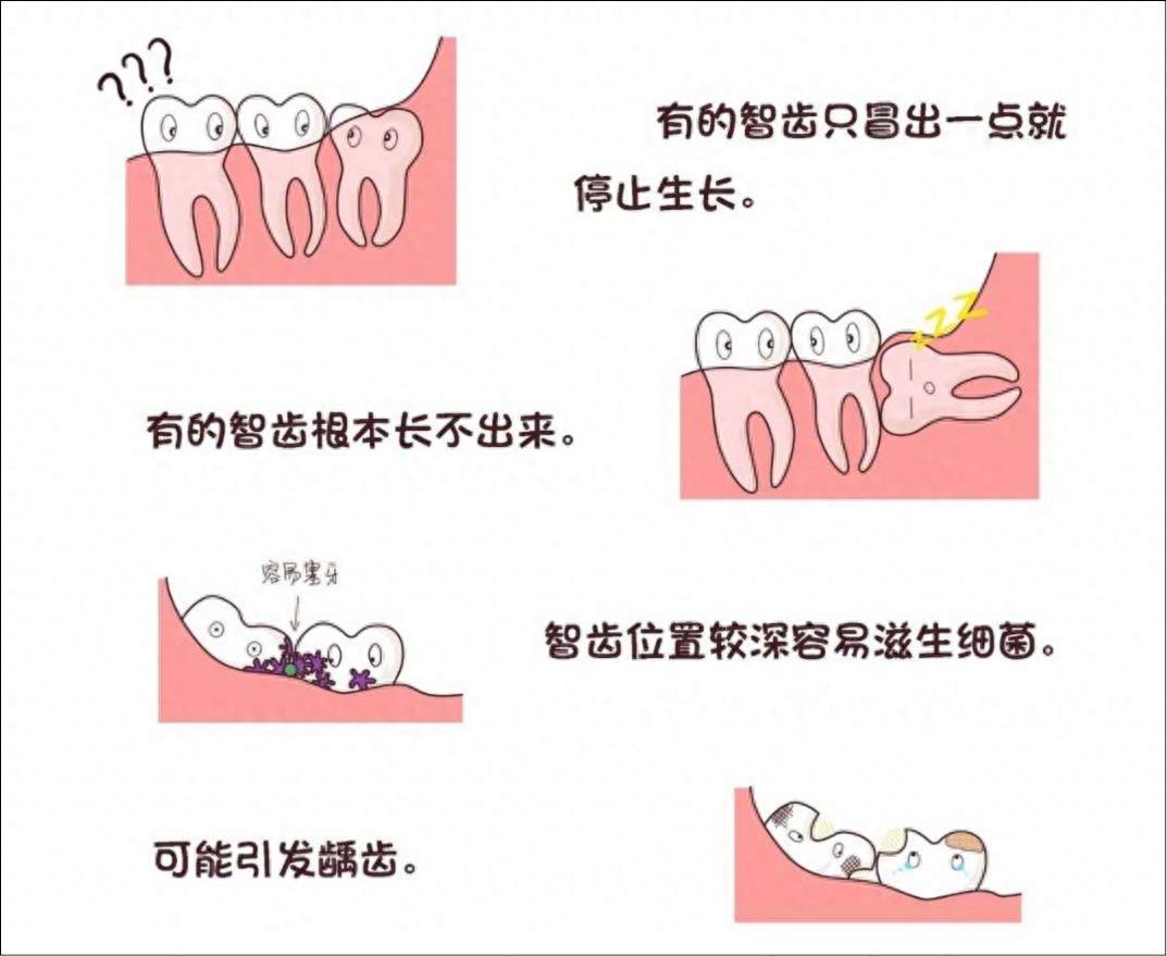 口腔常识手册之智齿，一组图带你了解智齿为什么疼