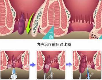 正常肛门图片和痔疮图片 女性痔疮图片