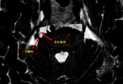 ​六旬大叔被“天下第一痛”折磨5年，吃饭都不香了