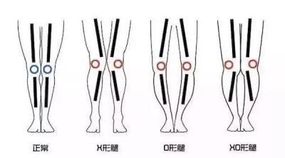 ​常见腿型不正O型腿要区分三种类型，不同类型练习方法不同